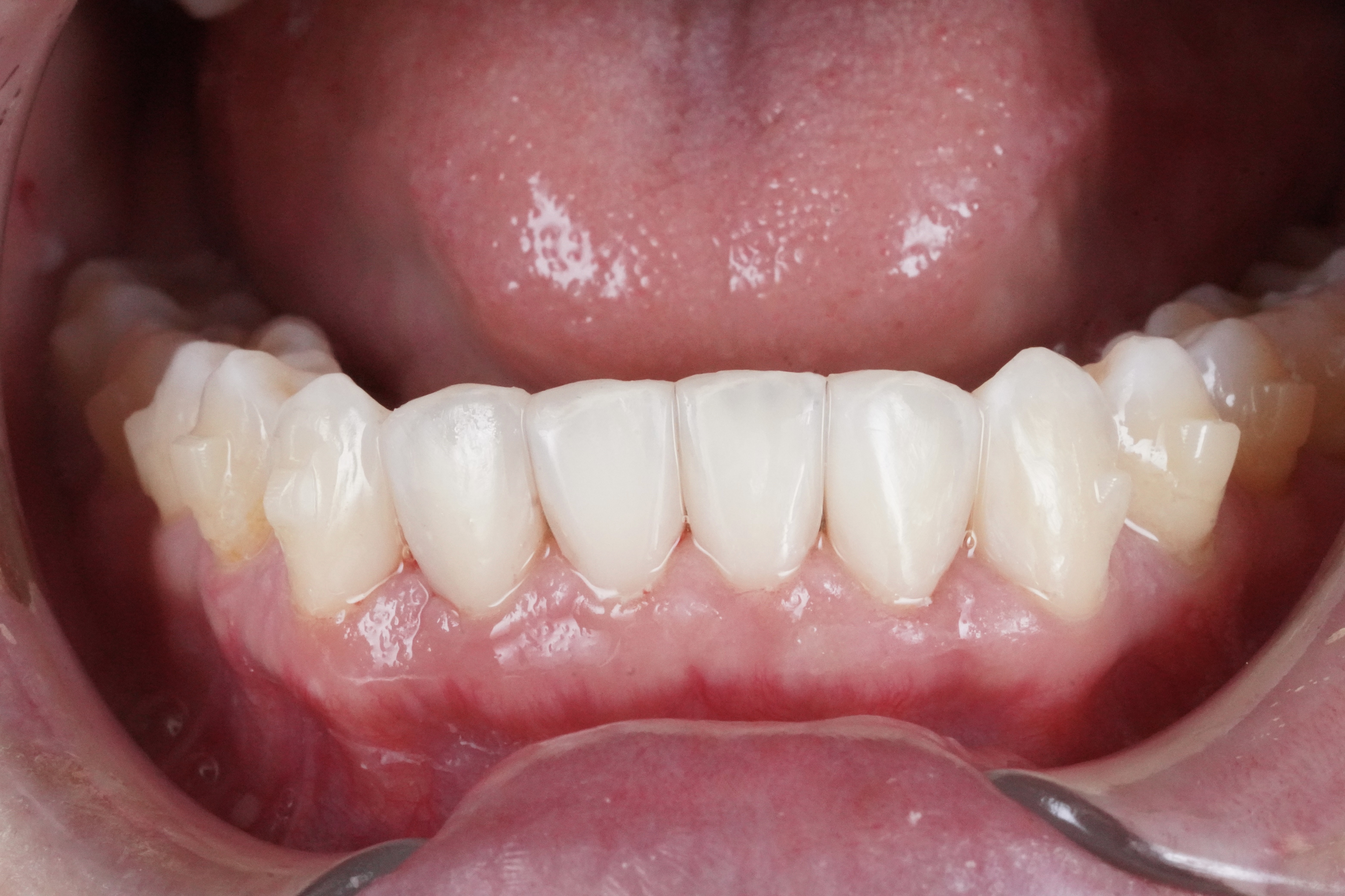 After treatment